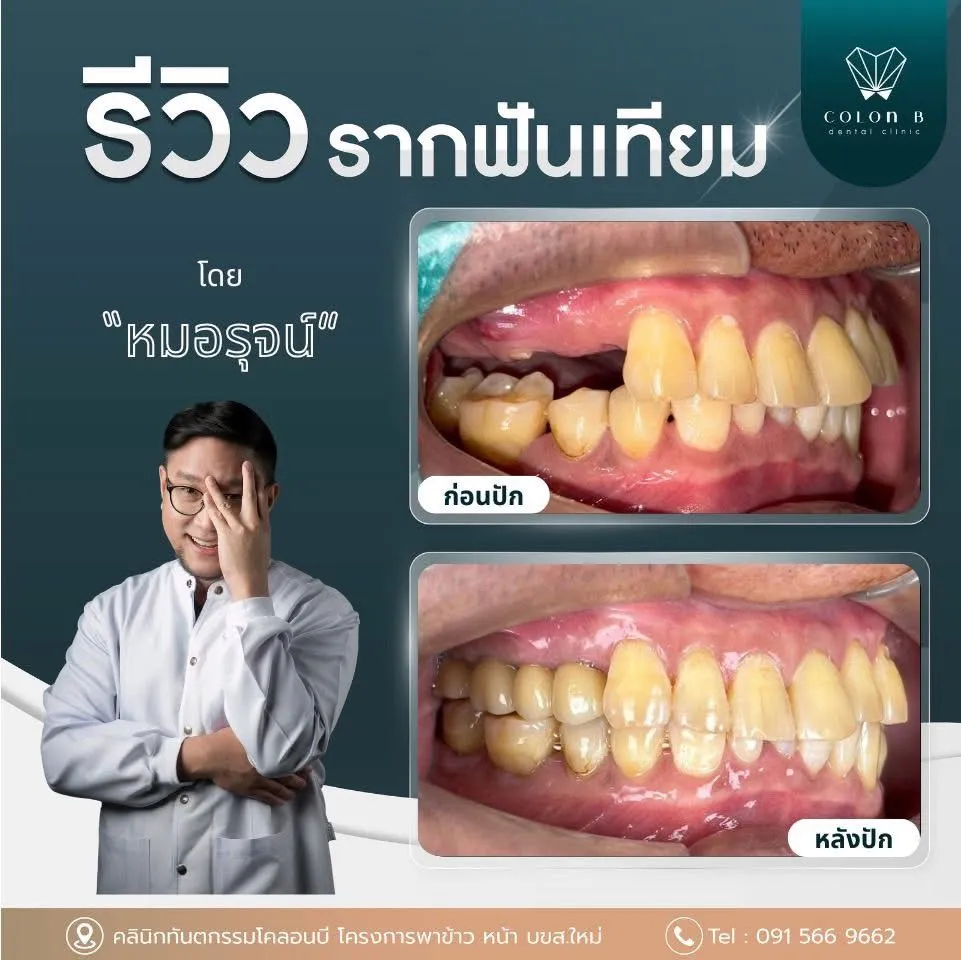 รีวิว รากฟันเทียม จากคนไข้จริง