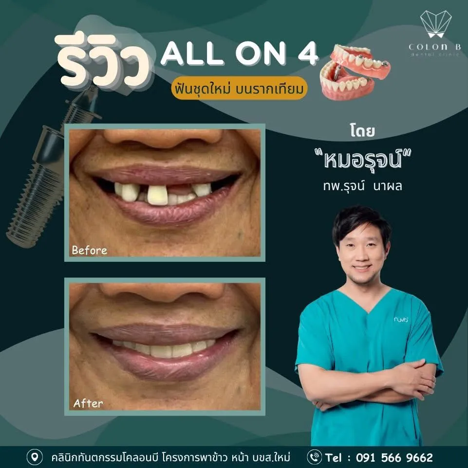 รีวิว รากฟันเทียม จากคนไข้จริง