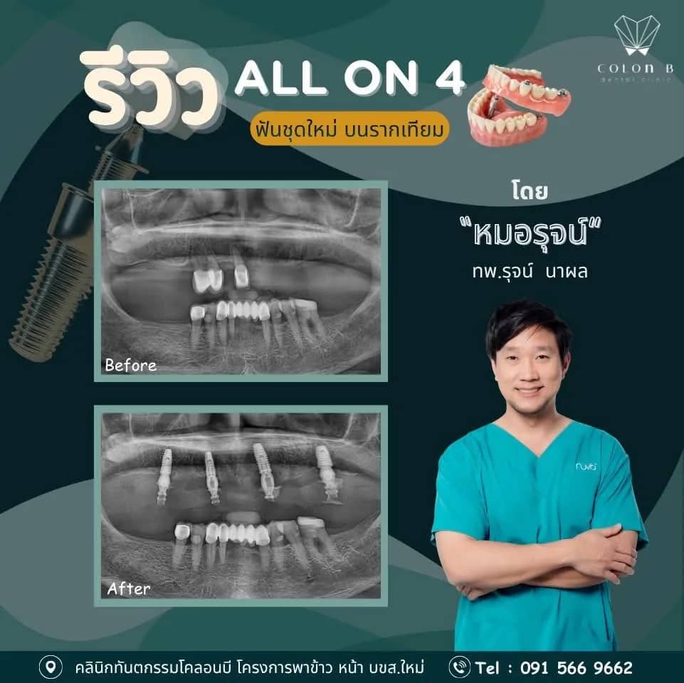 รีวิว รากฟันเทียม จากคนไข้จริง