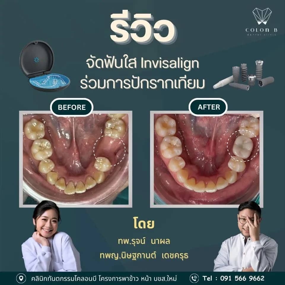 รีวิว รากฟันเทียม จากคนไข้จริง