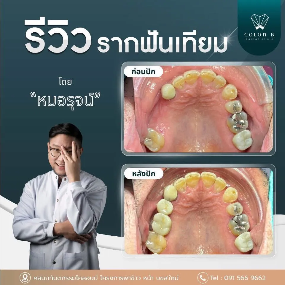 รีวิว รากฟันเทียม จากคนไข้จริง