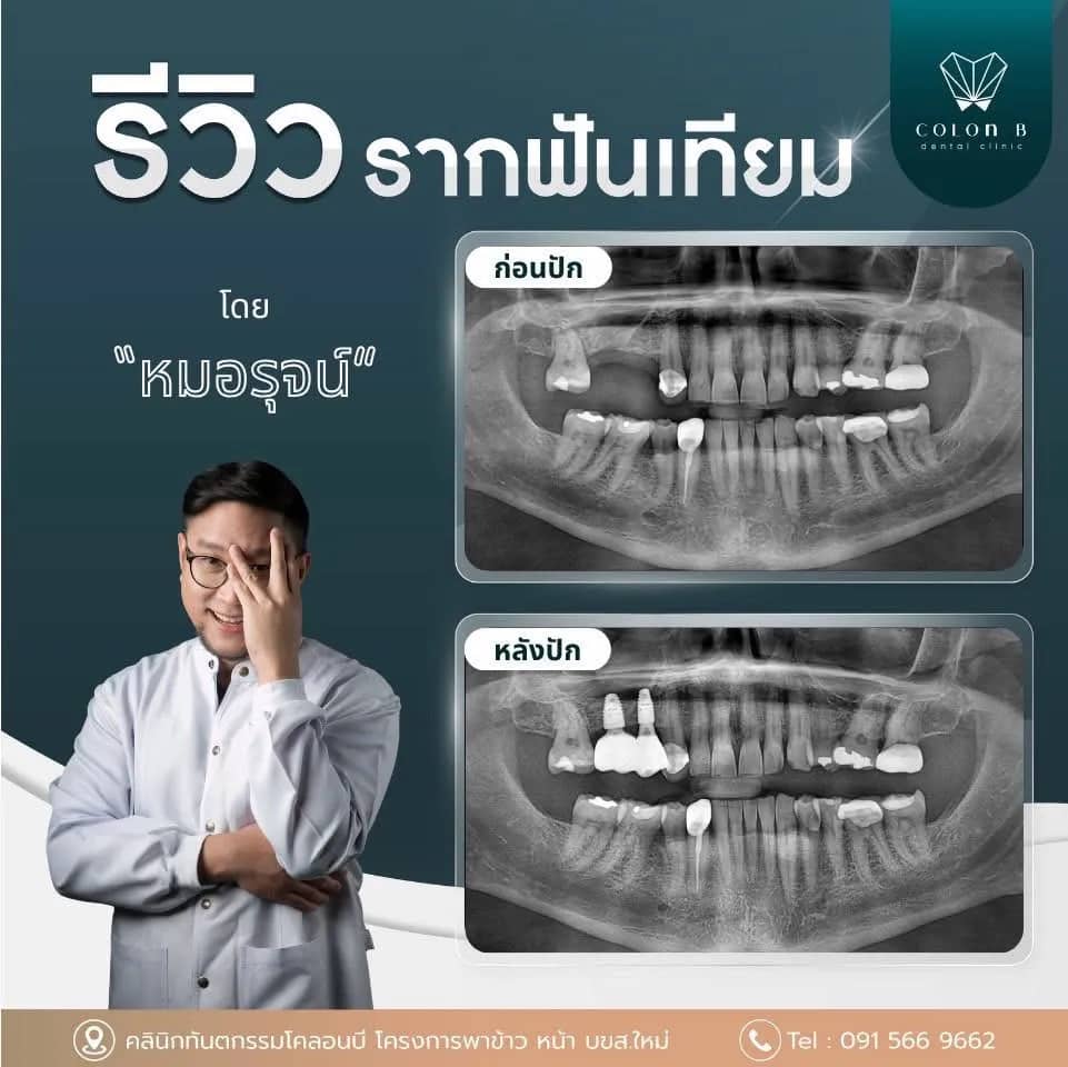 รีวิว รากฟันเทียม จากคนไข้จริง
