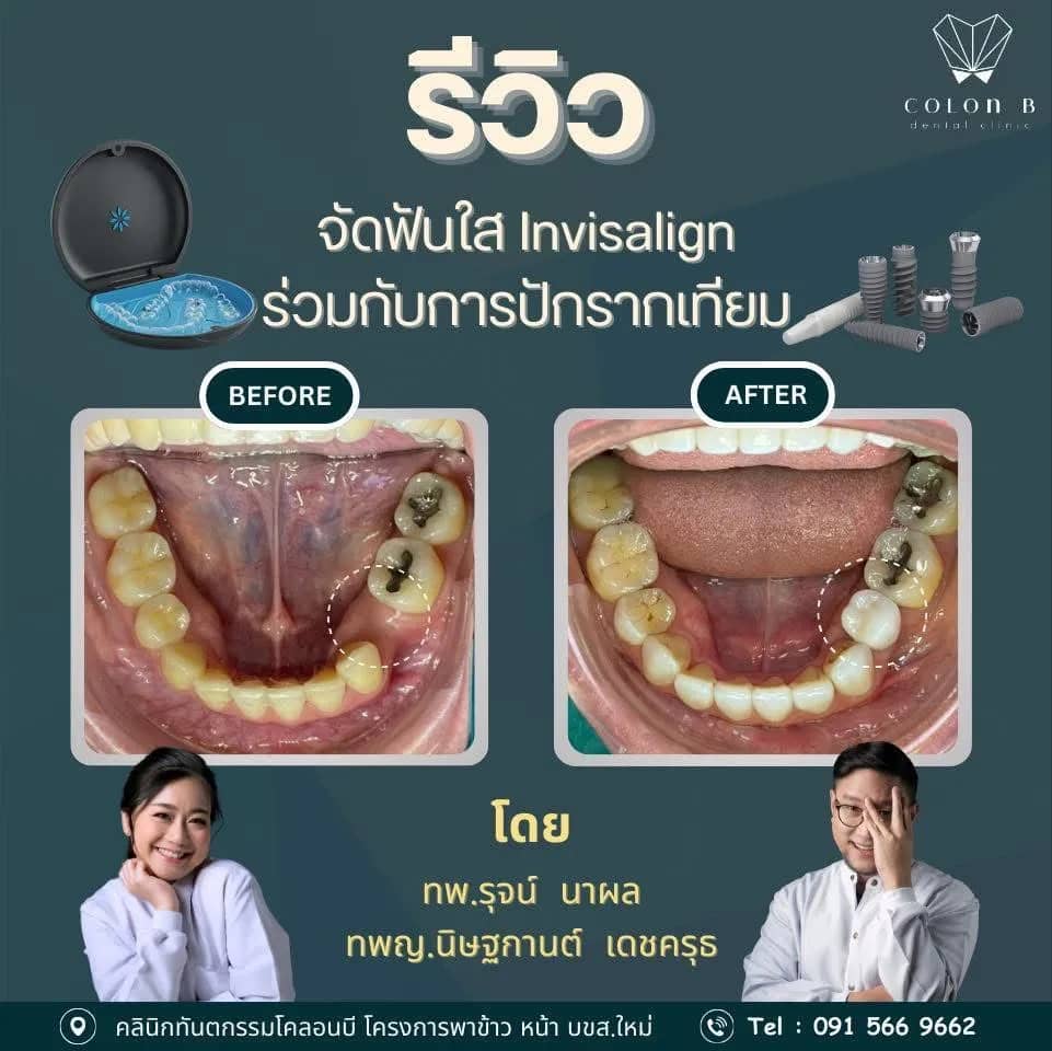 รีวิว รากฟันเทียม จากคนไข้จริง