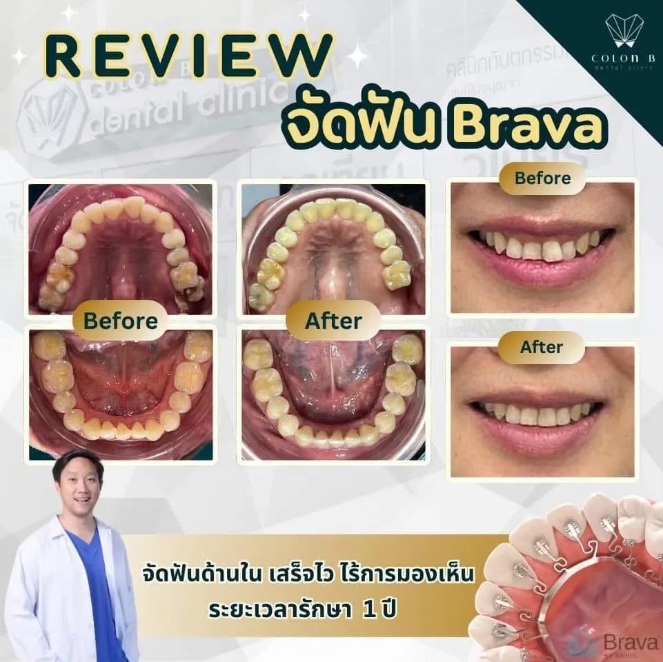 รีวิว จัดฟัน จากคนไข้จริง