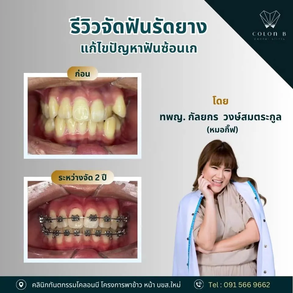 รีวิว จัดฟัน จากคนไข้จริง