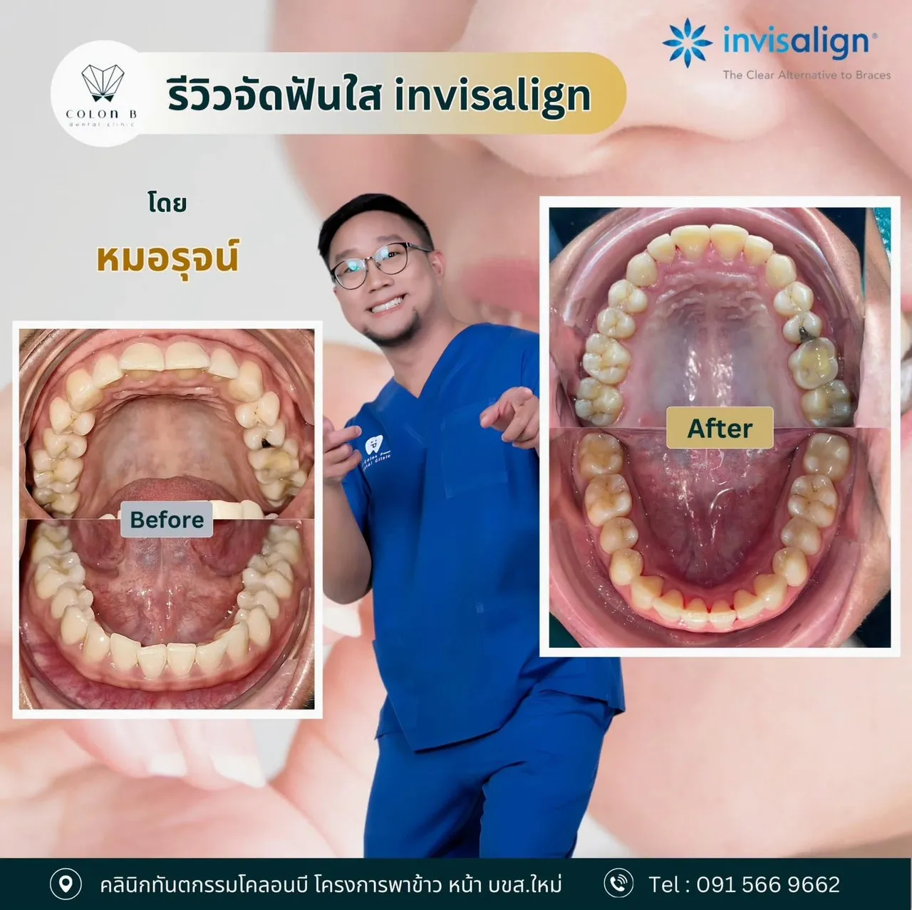 รีวิว จัดฟัน จากคนไข้จริง
