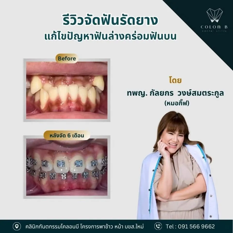 รีวิว จัดฟัน จากคนไข้จริง