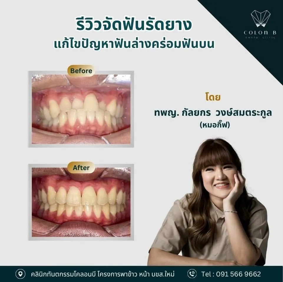 รีวิว จัดฟัน จากคนไข้จริง