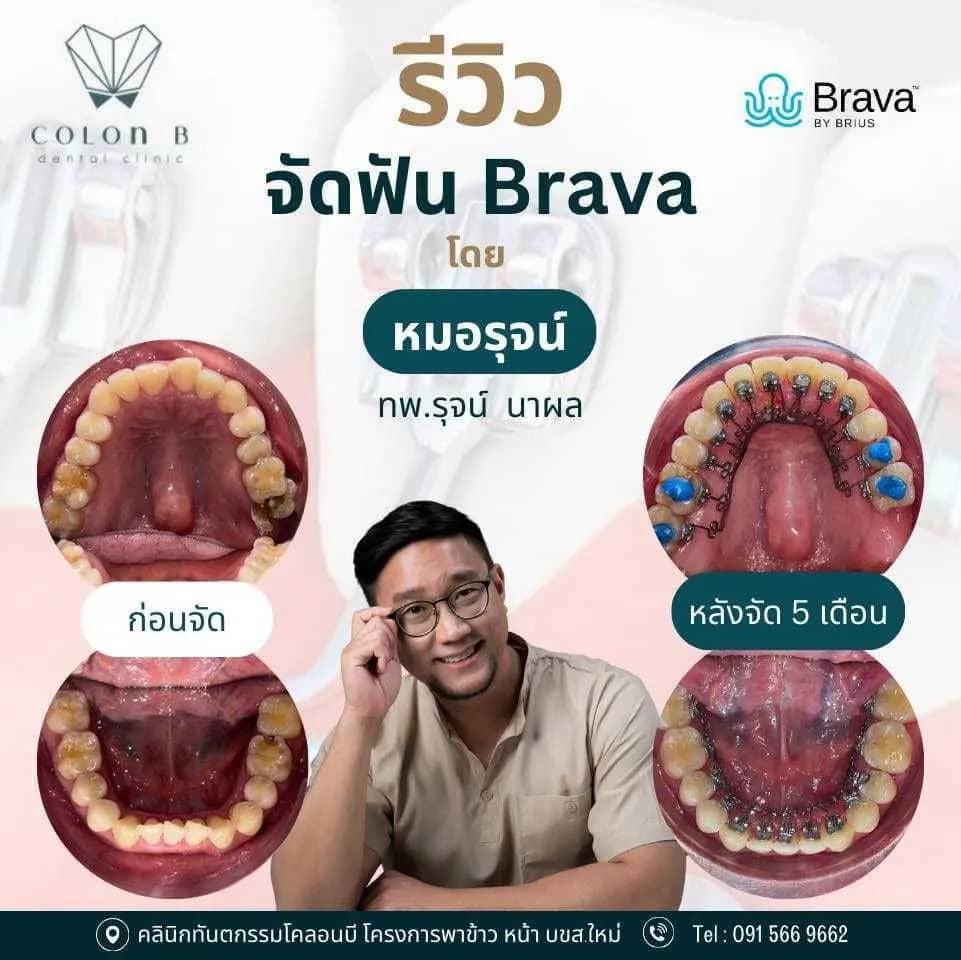 รีวิว จัดฟัน จากคนไข้จริง