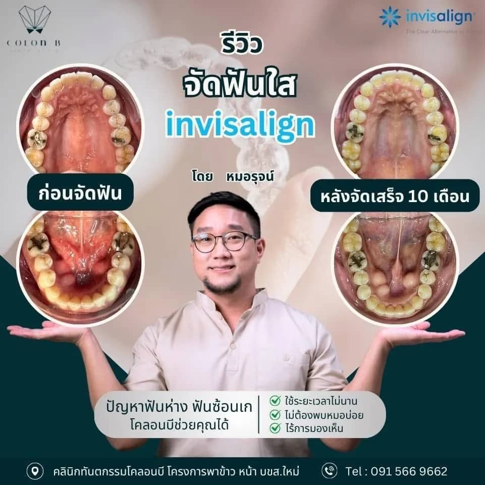 รีวิว จัดฟัน จากคนไข้จริง