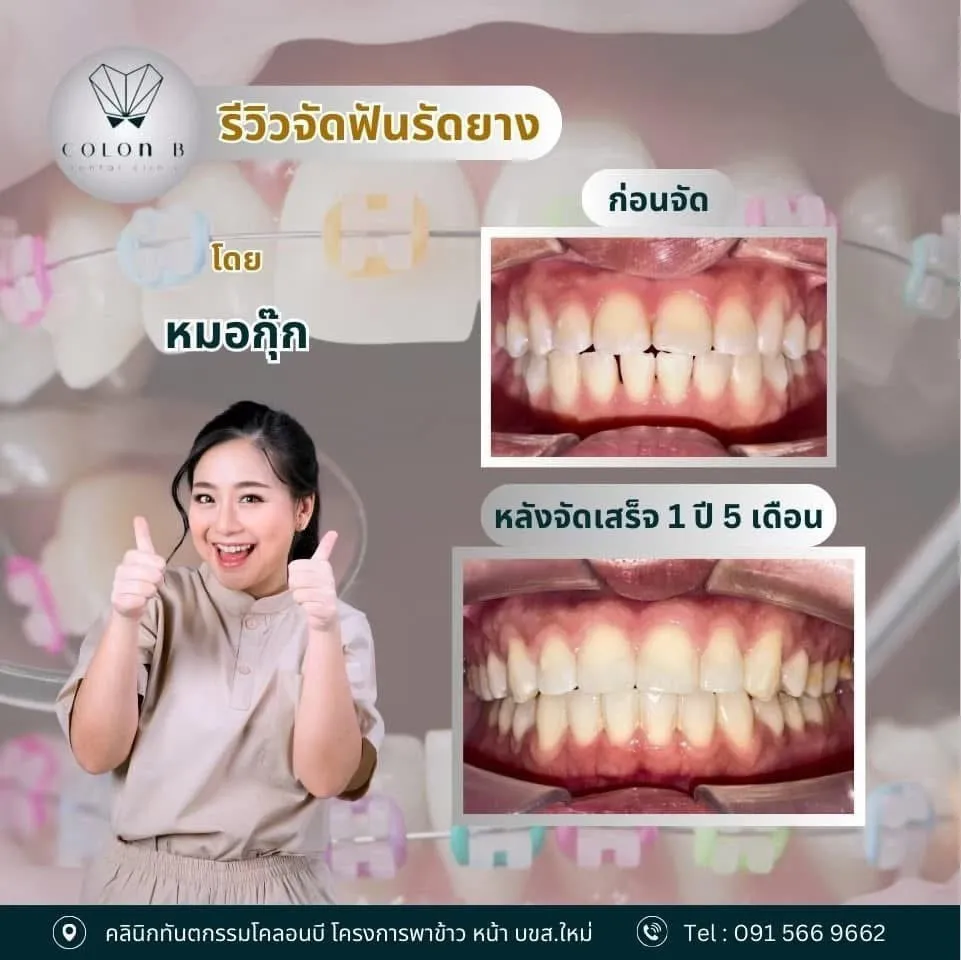 รีวิว จัดฟัน จากคนไข้จริง