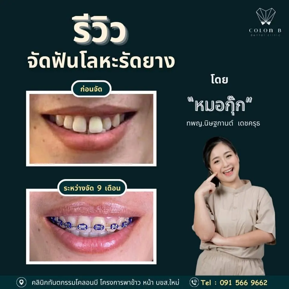รีวิว จัดฟัน จากคนไข้จริง