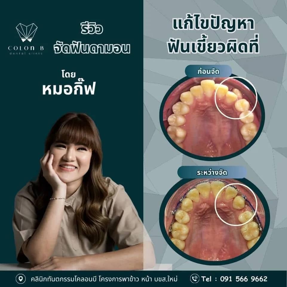 รีวิว จัดฟัน จากคนไข้จริง