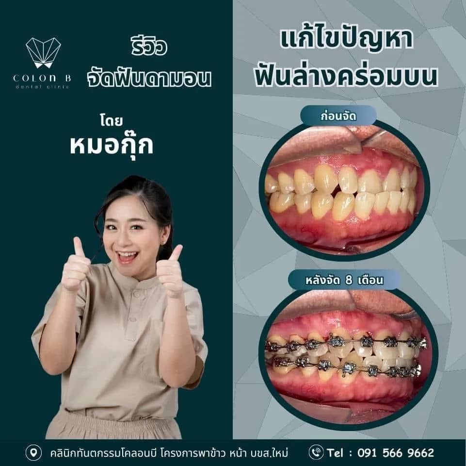 รีวิว จัดฟัน จากคนไข้จริง