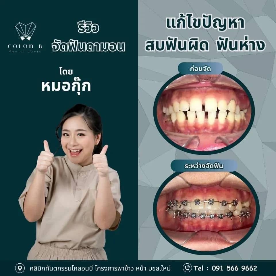 รีวิว จัดฟัน จากคนไข้จริง
