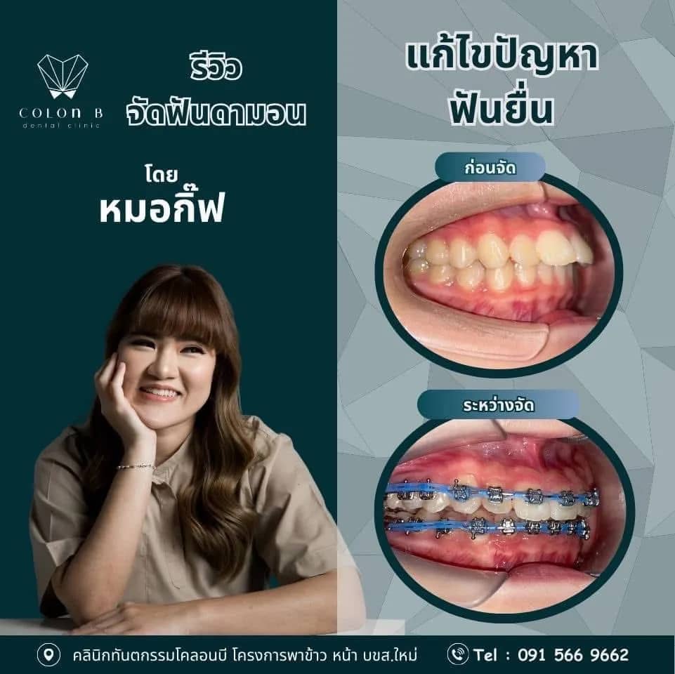 รีวิว จัดฟัน จากคนไข้จริง