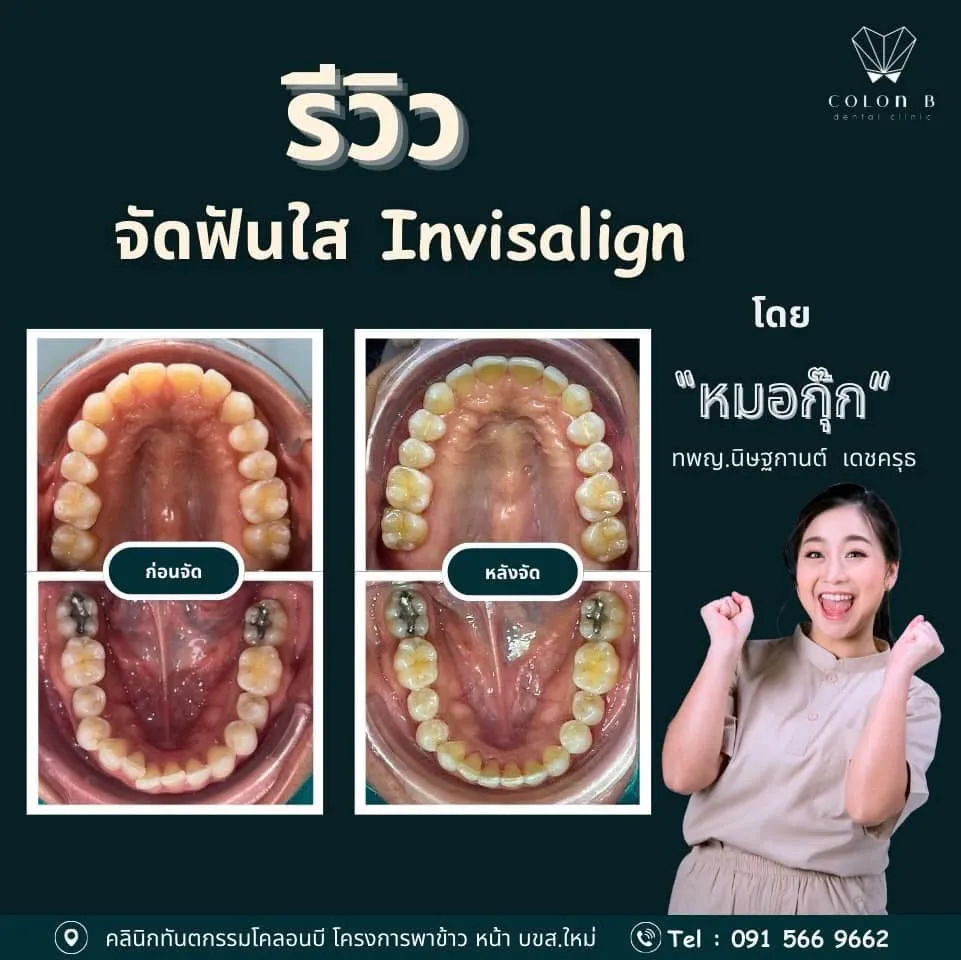 รีวิว จัดฟัน จากคนไข้จริง