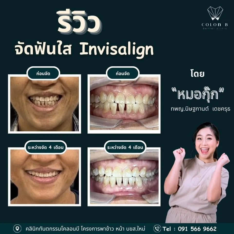 รีวิว จัดฟัน จากคนไข้จริง