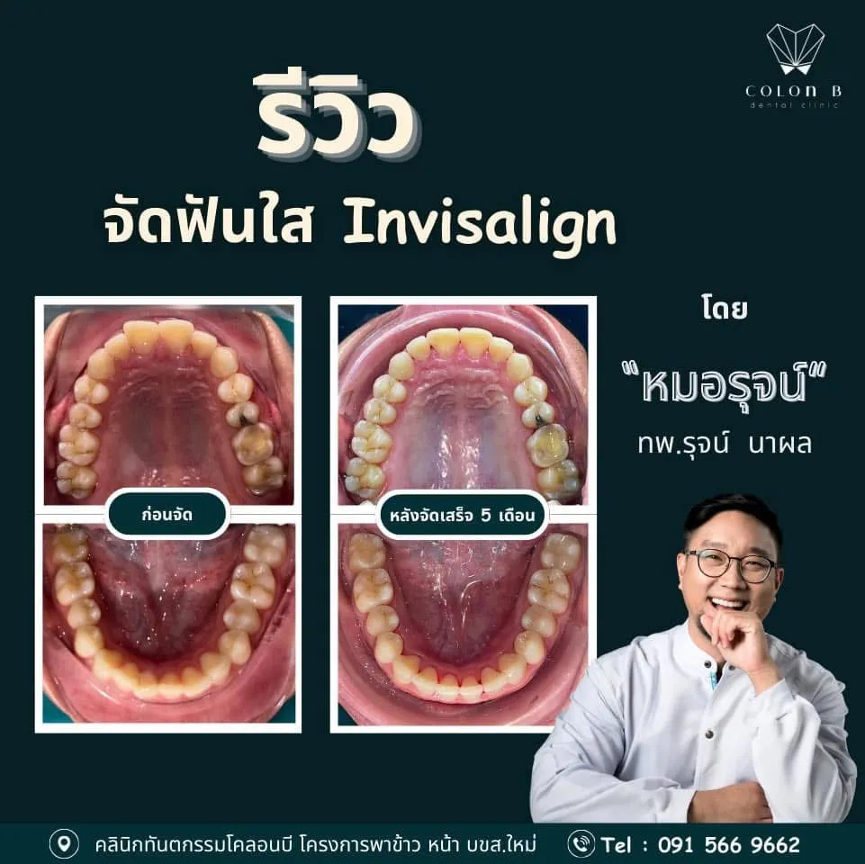 รีวิว จัดฟัน จากคนไข้จริง