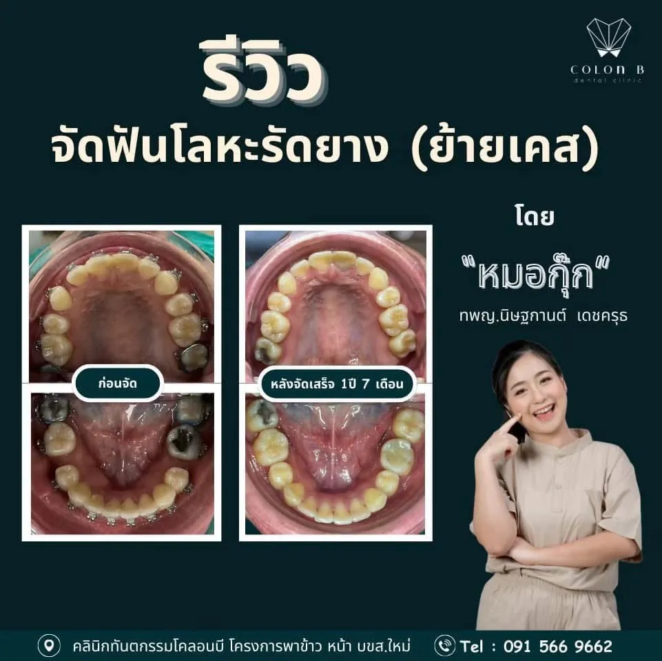 รีวิว จัดฟัน จากคนไข้จริง