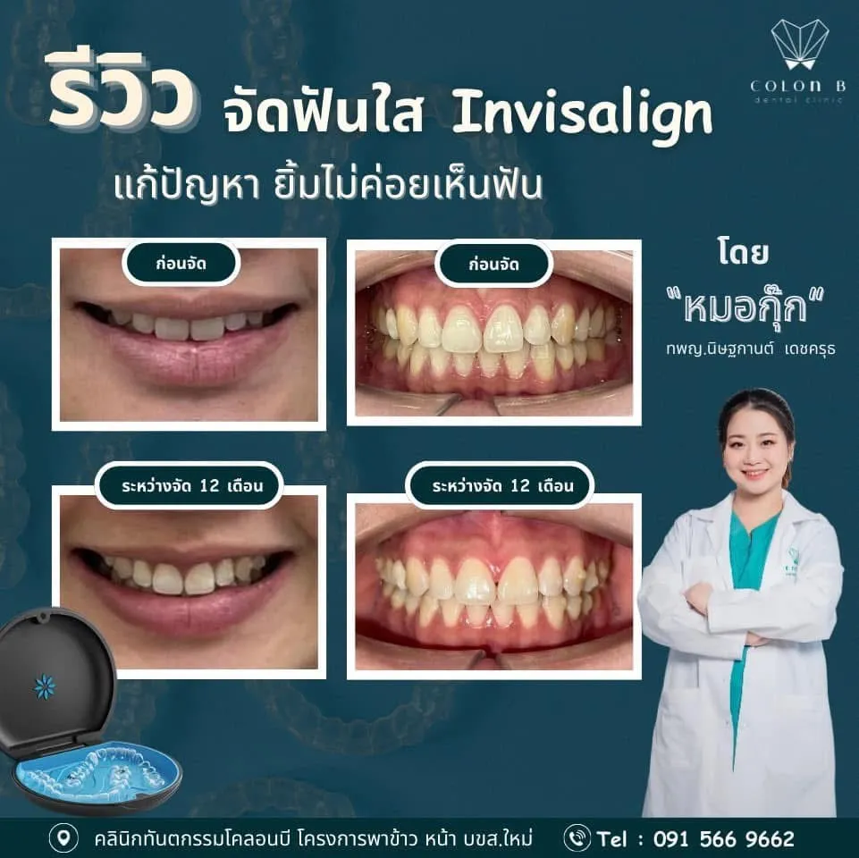 รีวิว จัดฟัน จากคนไข้จริง