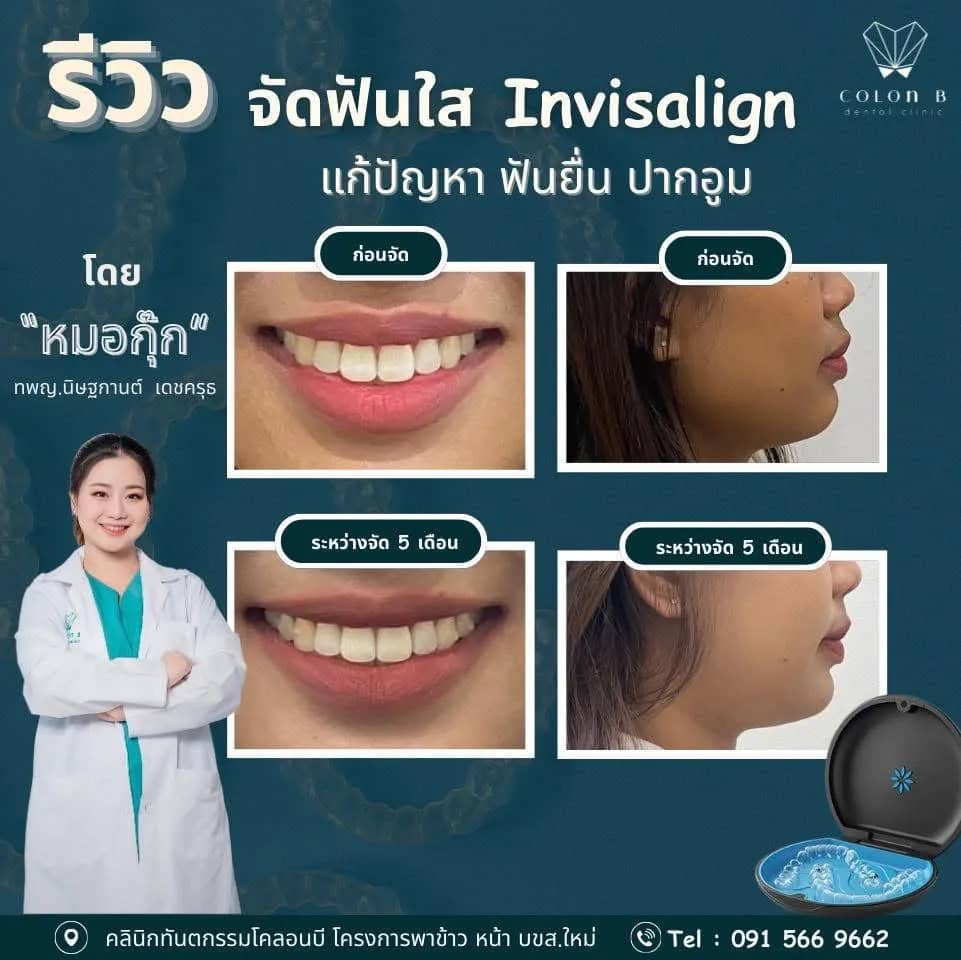 รีวิว จัดฟัน จากคนไข้จริง