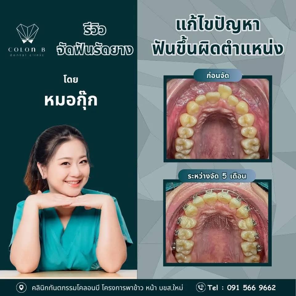รีวิว จัดฟัน จากคนไข้จริง