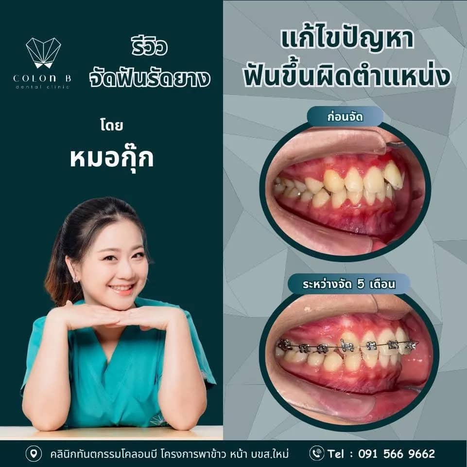 รีวิว จัดฟัน จากคนไข้จริง