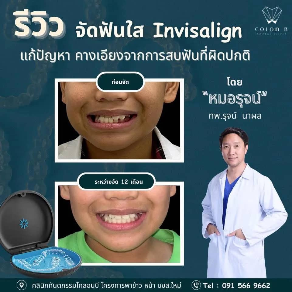 รีวิว จัดฟัน จากคนไข้จริง