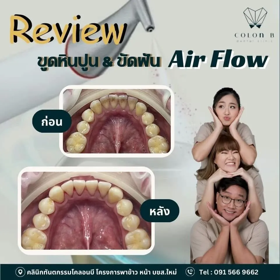 รีวิว ขูดหินปูน + Airflow จากคนไข้จริง