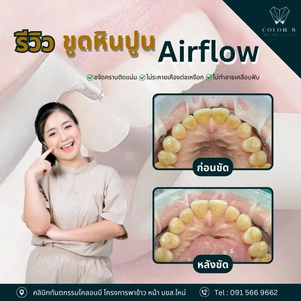 รีวิว ขูดหินปูน + Airflow จากคนไข้จริง