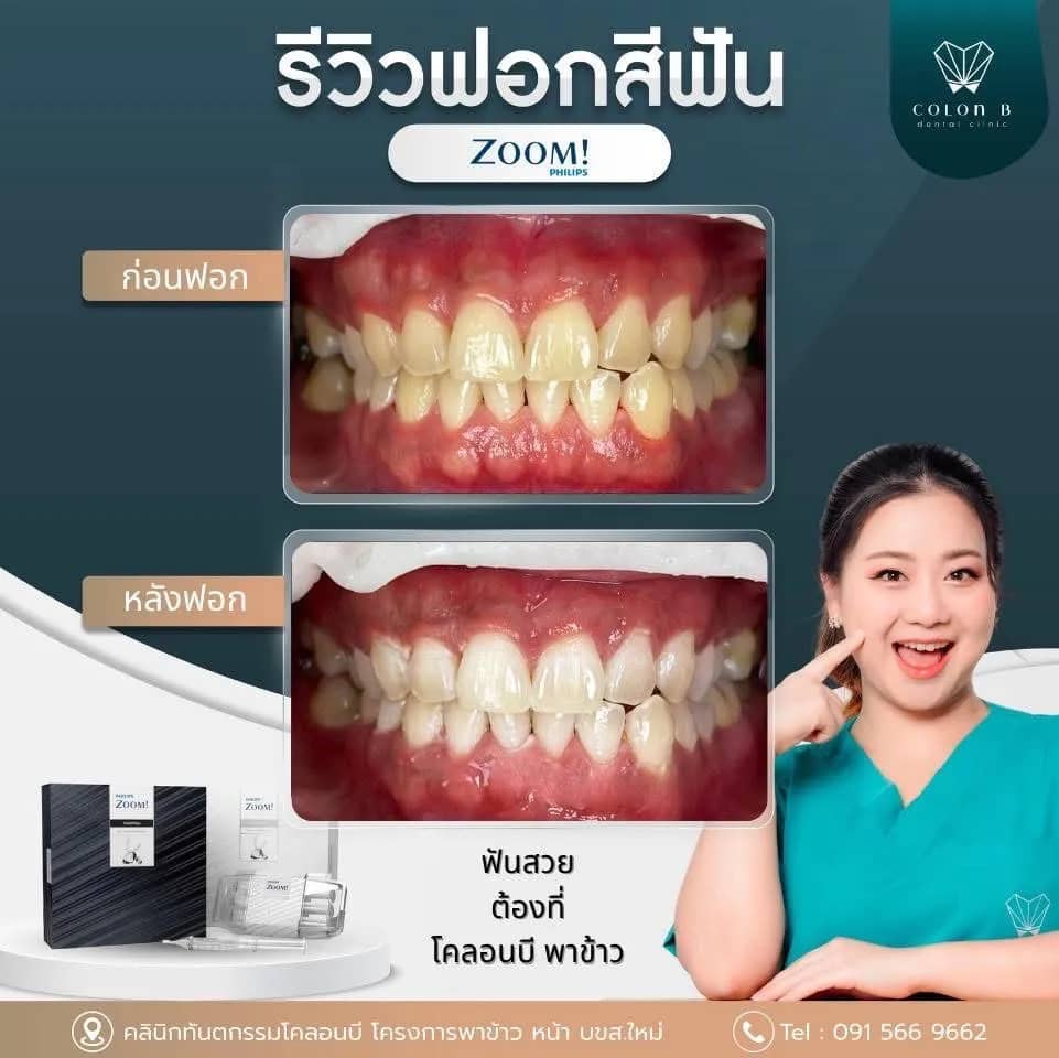 รีวิว ฟอกสีฟัน จากคนไข้จริง