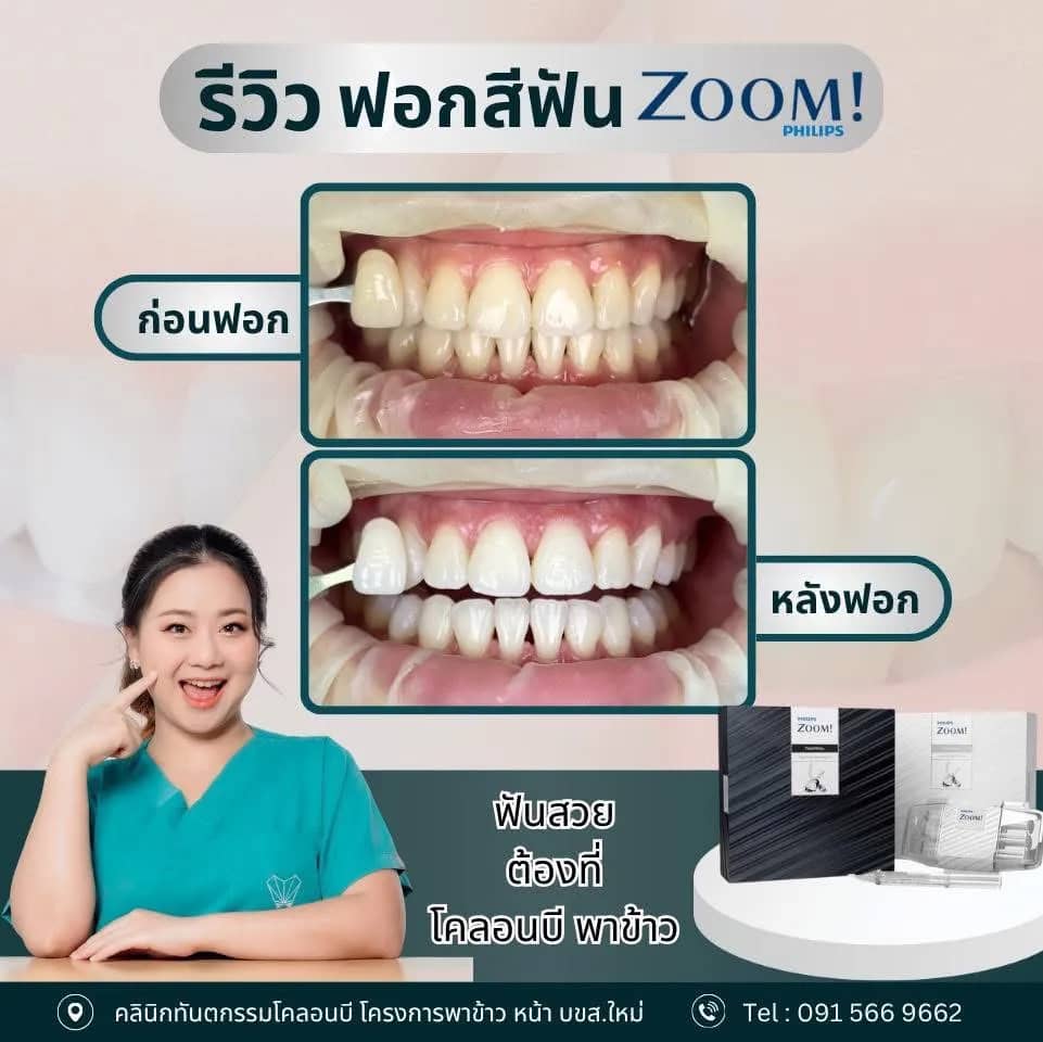 รีวิว ฟอกสีฟัน จากคนไข้จริง