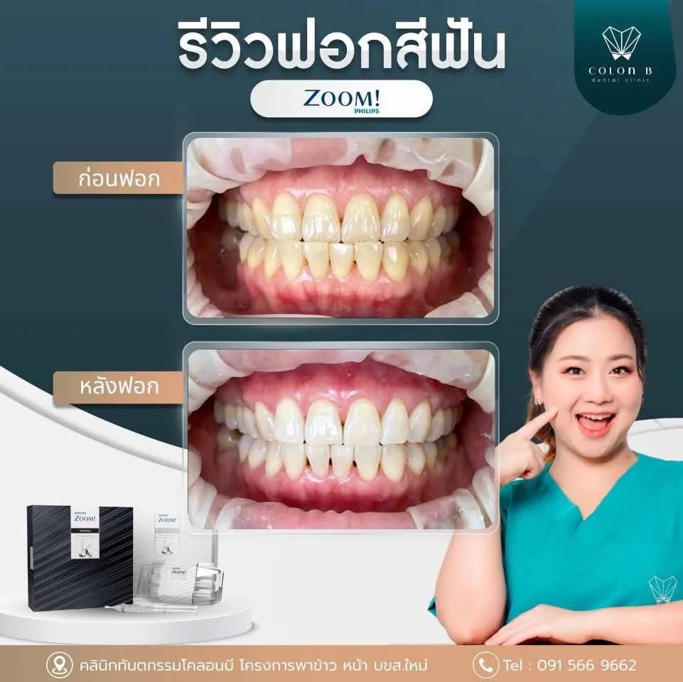 รีวิว ฟอกสีฟัน จากคนไข้จริง