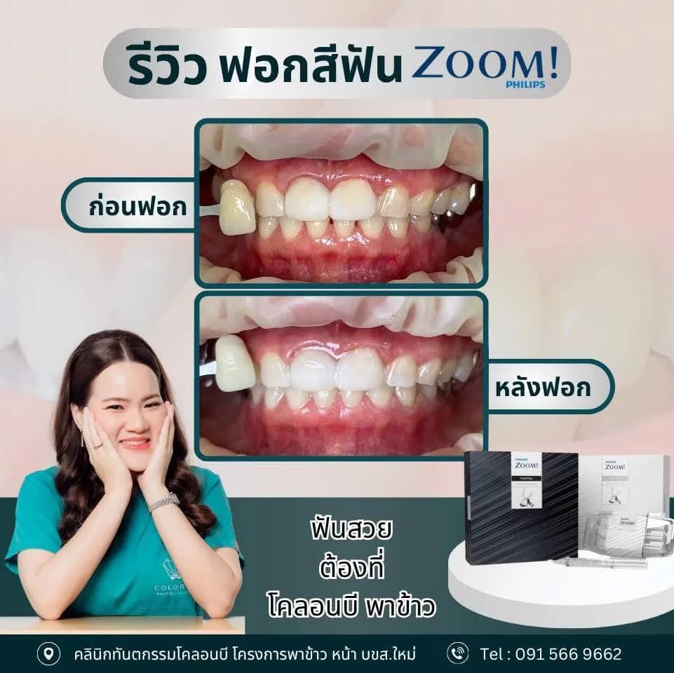 รีวิว ฟอกสีฟัน จากคนไข้จริง