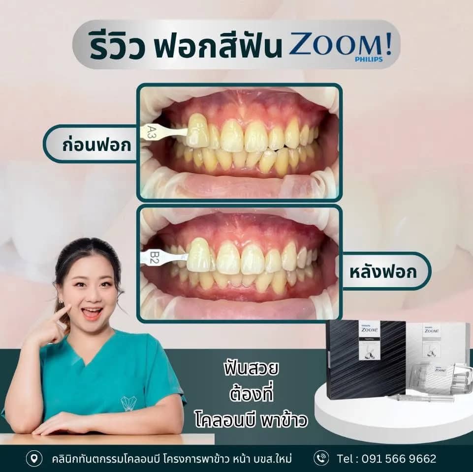 รีวิว ฟอกสีฟัน จากคนไข้จริง