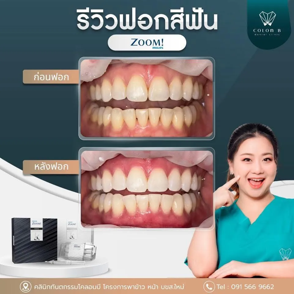 รีวิว ฟอกสีฟัน จากคนไข้จริง