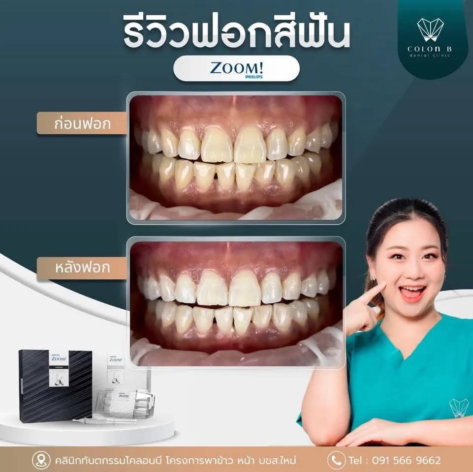รีวิว ฟอกสีฟัน จากคนไข้จริง
