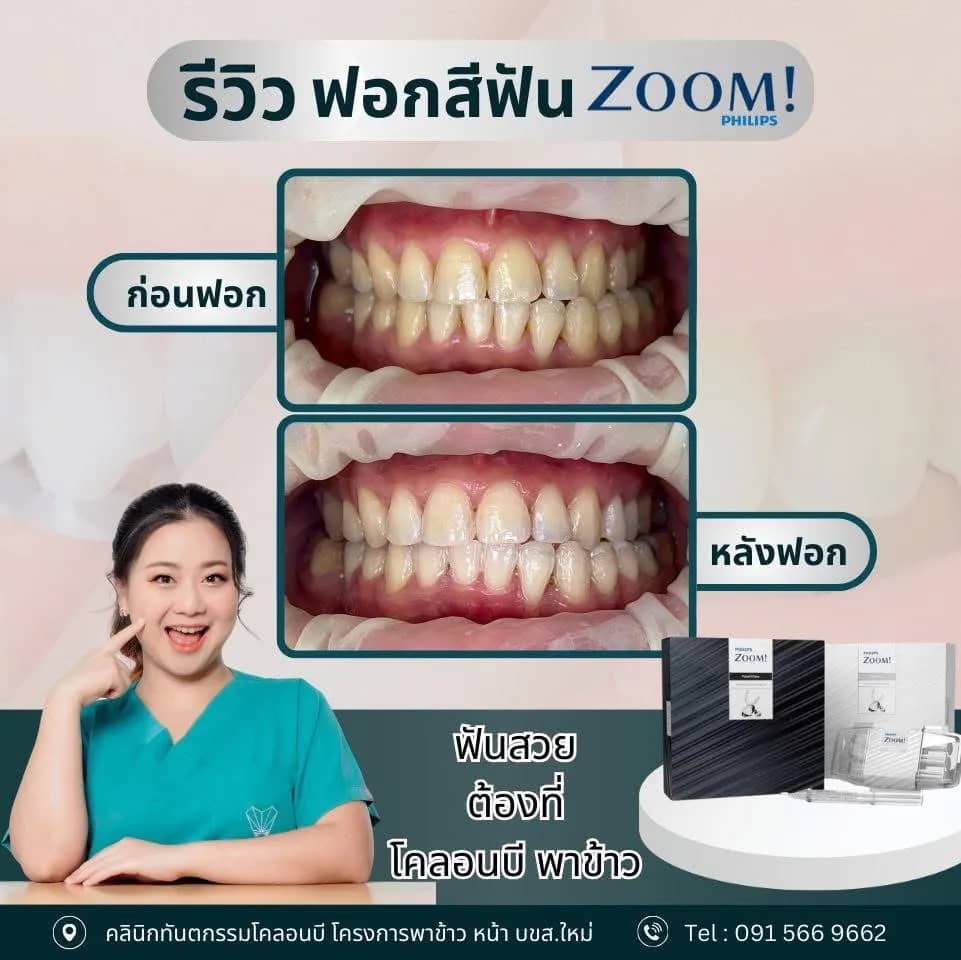 รีวิว ฟอกสีฟัน จากคนไข้จริง