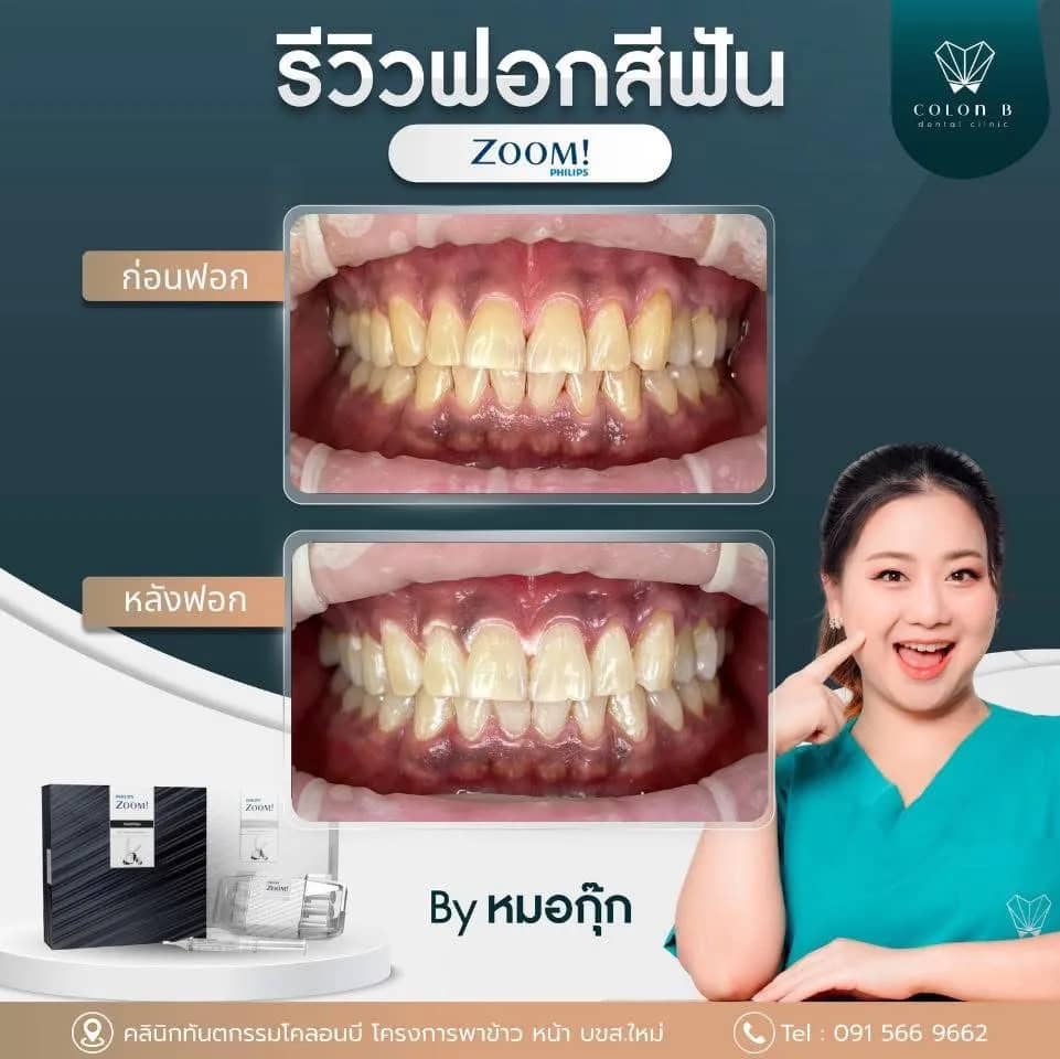 รีวิว ฟอกสีฟัน จากคนไข้จริง