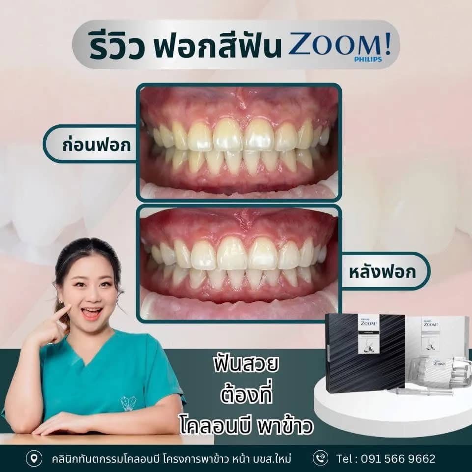 รีวิว ฟอกสีฟัน จากคนไข้จริง