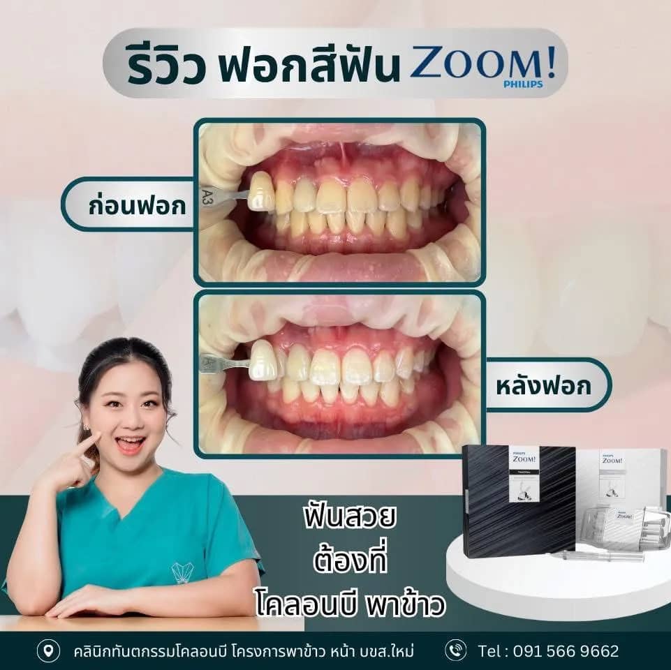 รีวิว ฟอกสีฟัน จากคนไข้จริง