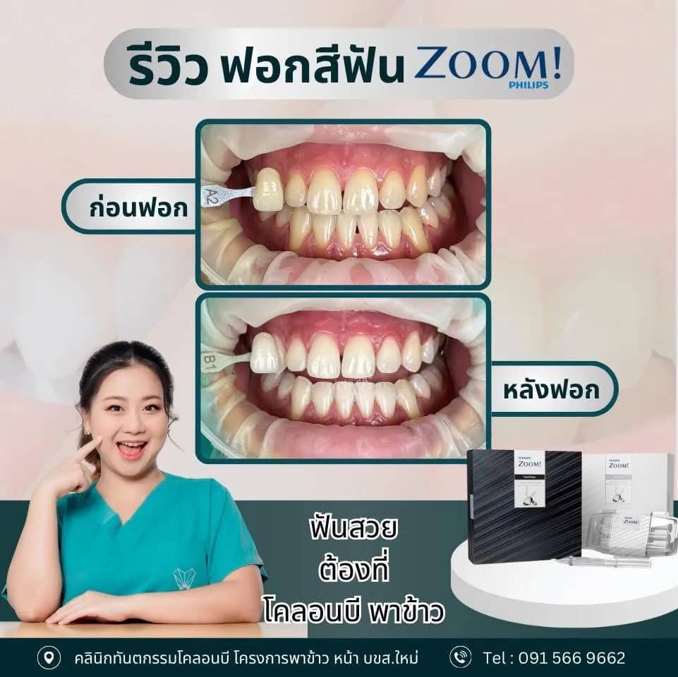 รีวิว ฟอกสีฟัน จากคนไข้จริง