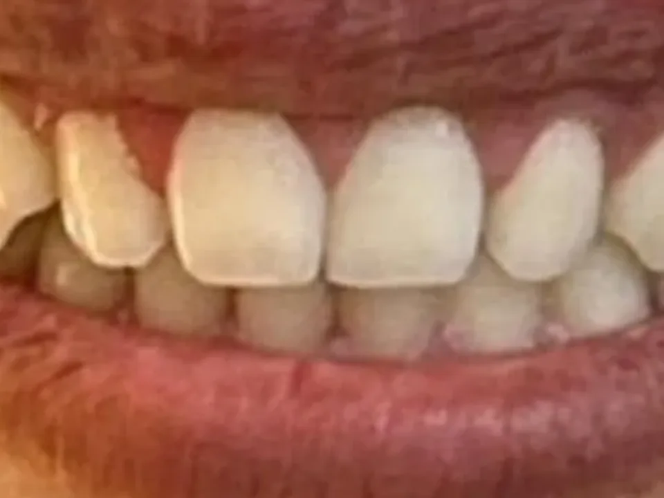 จัดฟันใส Invisalign ก่อนรักษา